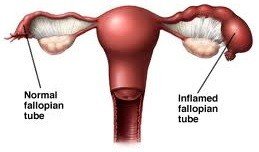 輸卵管水腫之治療